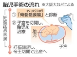 脊髄難病の胎児手術成功、阪大　母親の子宮切開で日本初