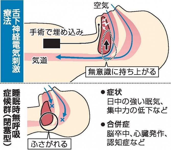 電気で舌刺激 睡眠時の気道確保　川崎医大病院、中四国で初導入