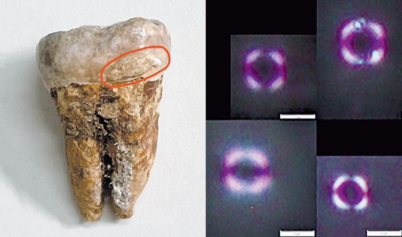 左は古墳時代の人骨の歯（赤丸内が歯石）。右は歯石から検出された炊いた米とみられるでんぷん粒