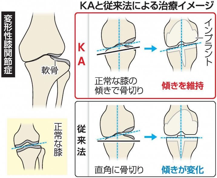 「変形性膝関節症」治療に新手術　川崎医大病院 本来の脚に近い形に