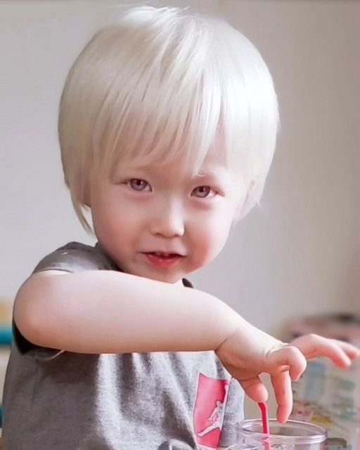 アルビノの小学生息子に“かっこいいやん！”、SNSで広がる理解 過去には 