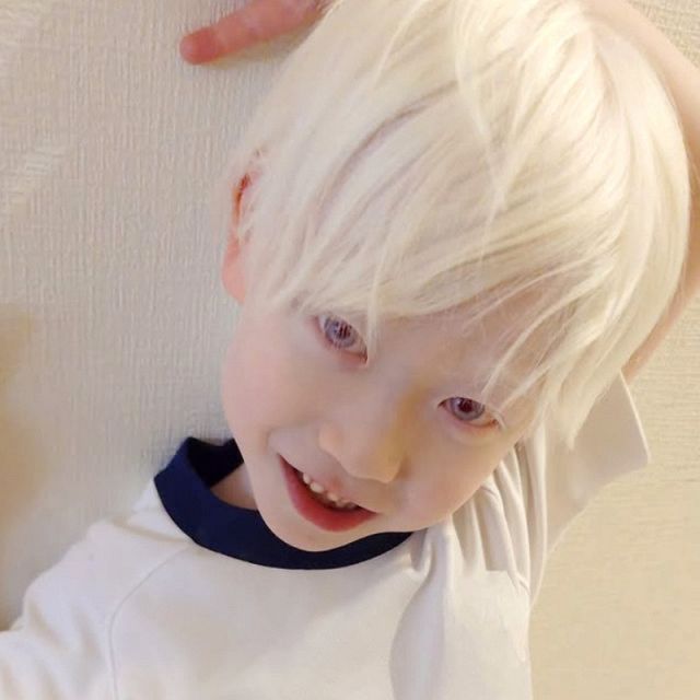 アルビノの小学生息子、「なんで白いの?」の疑問に母の想い…特別ではない「自分の色が好き」に:山陽新聞デジタル|さんデジ