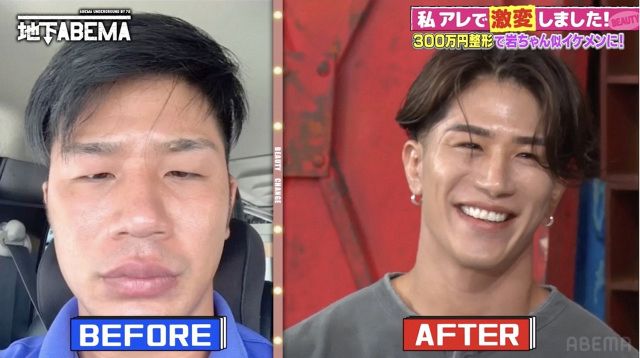 みうごんの整形前と現在の顔はどう変わった？施術箇所・総額費用と流出騒動の真相を徹底解剖